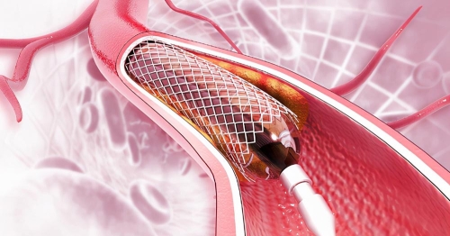Cateterismo Cardíaco - Angioplastia com STENT